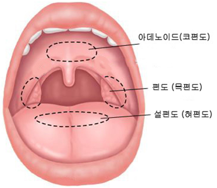 소아 급성 중이염