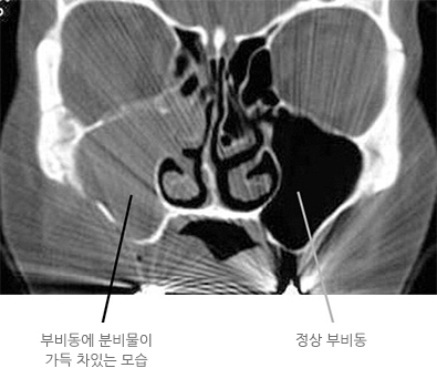 부비동염(축농증)